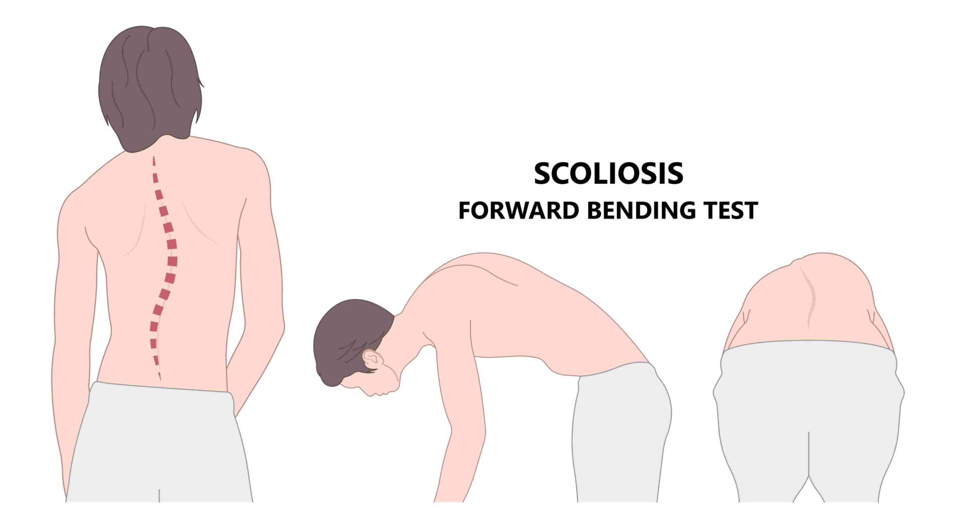 Escoliosis: una deformidad en la columna vertebral que afecta al 6% de la población juvenil en el mundo