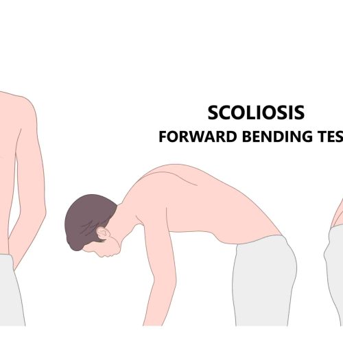 Escoliosis: una deformidad en la columna vertebral que afecta al 6% de la población juvenil en el mundo