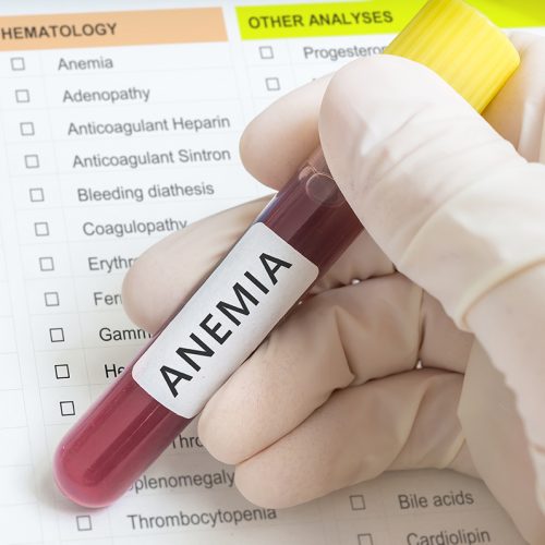 Anemia podría revelar enfermedad de la sangre en adultos